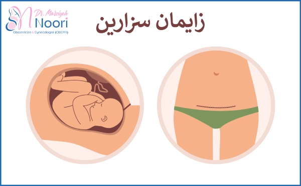 زایمان سزارین
