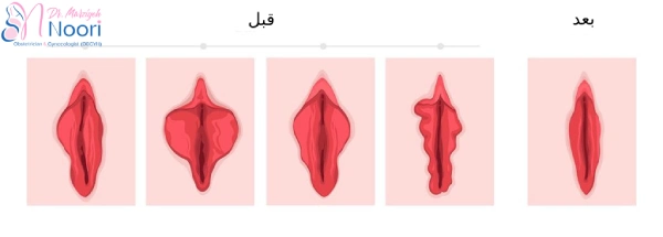لابیاپلاستی