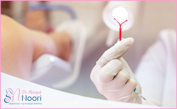 تعبیه دستگاه IUD 