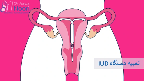  دستگاه IUD 