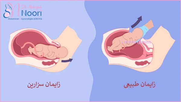 تفاوت مدت زمان زایمان طبیعی و سزارین