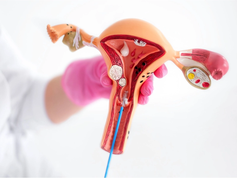 هزینه عمل هیستروسکوپی