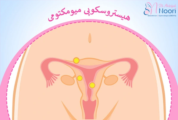هیستروسکوپی میومکتومی