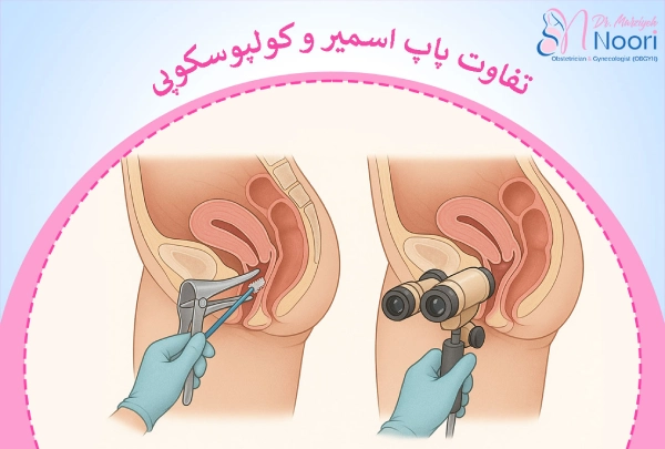 تفاوت پاپ اسمیر و کولپوسکوپی