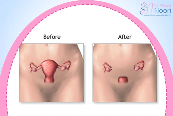 هیسترکتومی